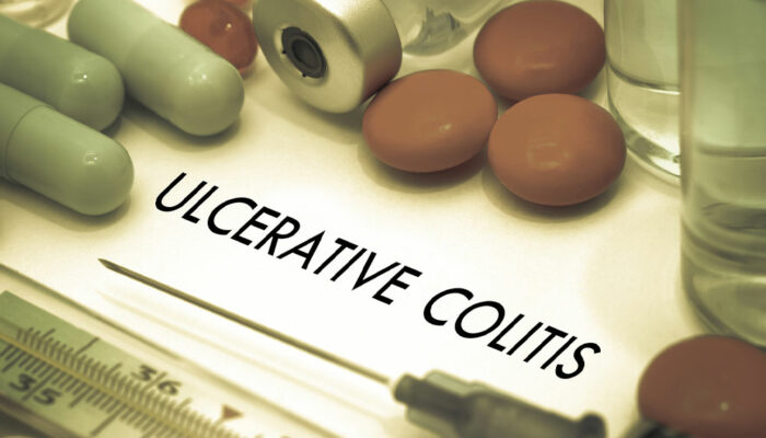 Signs and complications of ulcerative colitis